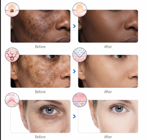 Masque Beauté LED YELHASKIN